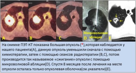 Как выглядит рак после удаления Фото Доброкачественных Опухолей Молочной Железы - Naikomt.ru